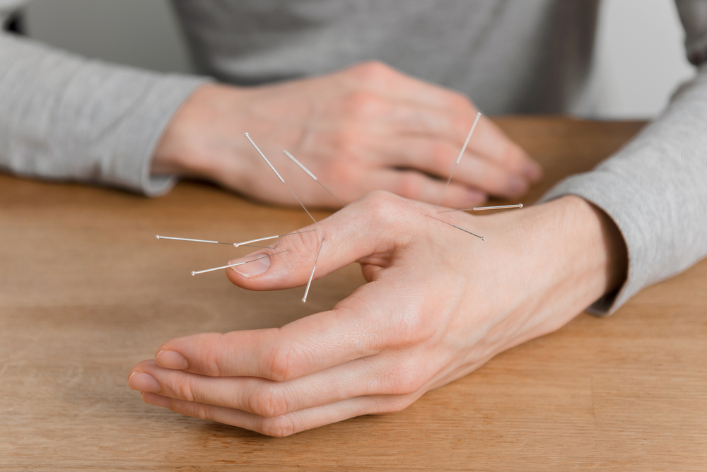 Acupuncture needles being inserted into a person's body to alleviate pain.